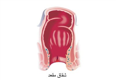 شقاق مقعد