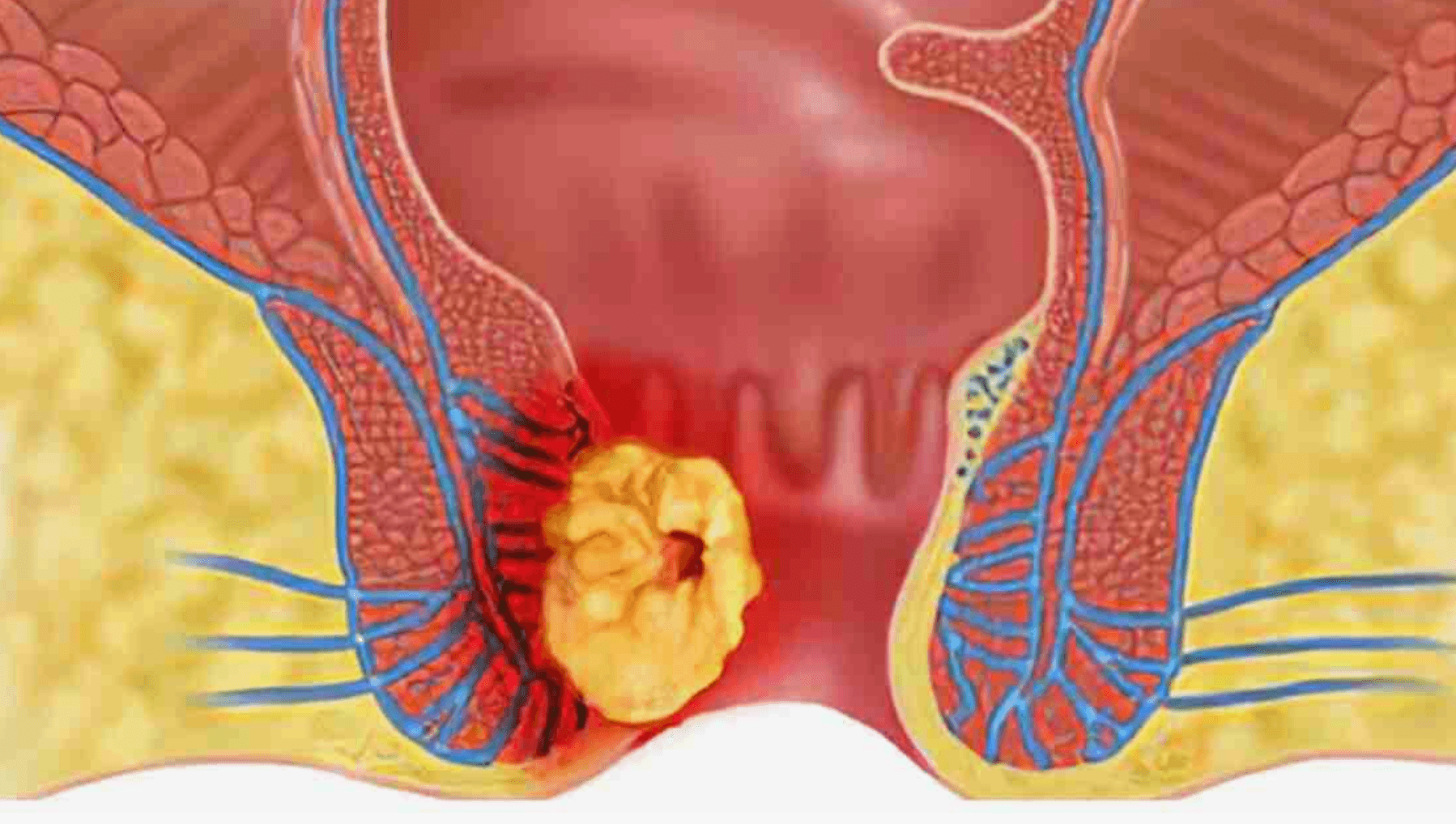 Anal-Fistul-Cesitleri-Nelerdir