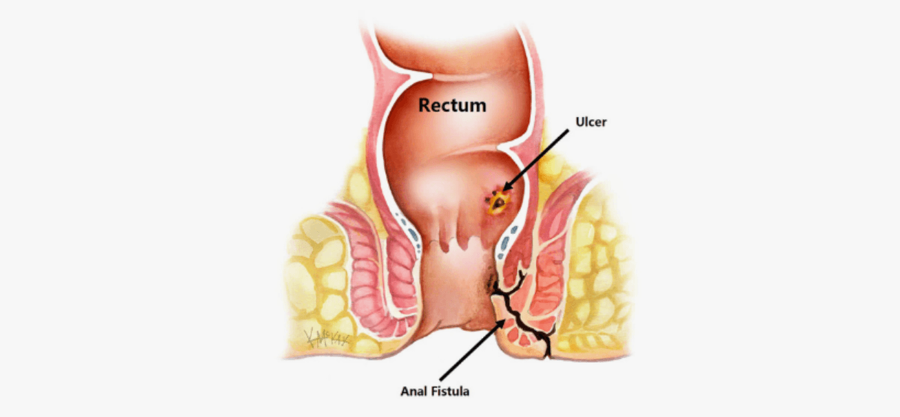 Anal-Fistul-Cesitleri-Nelerdir