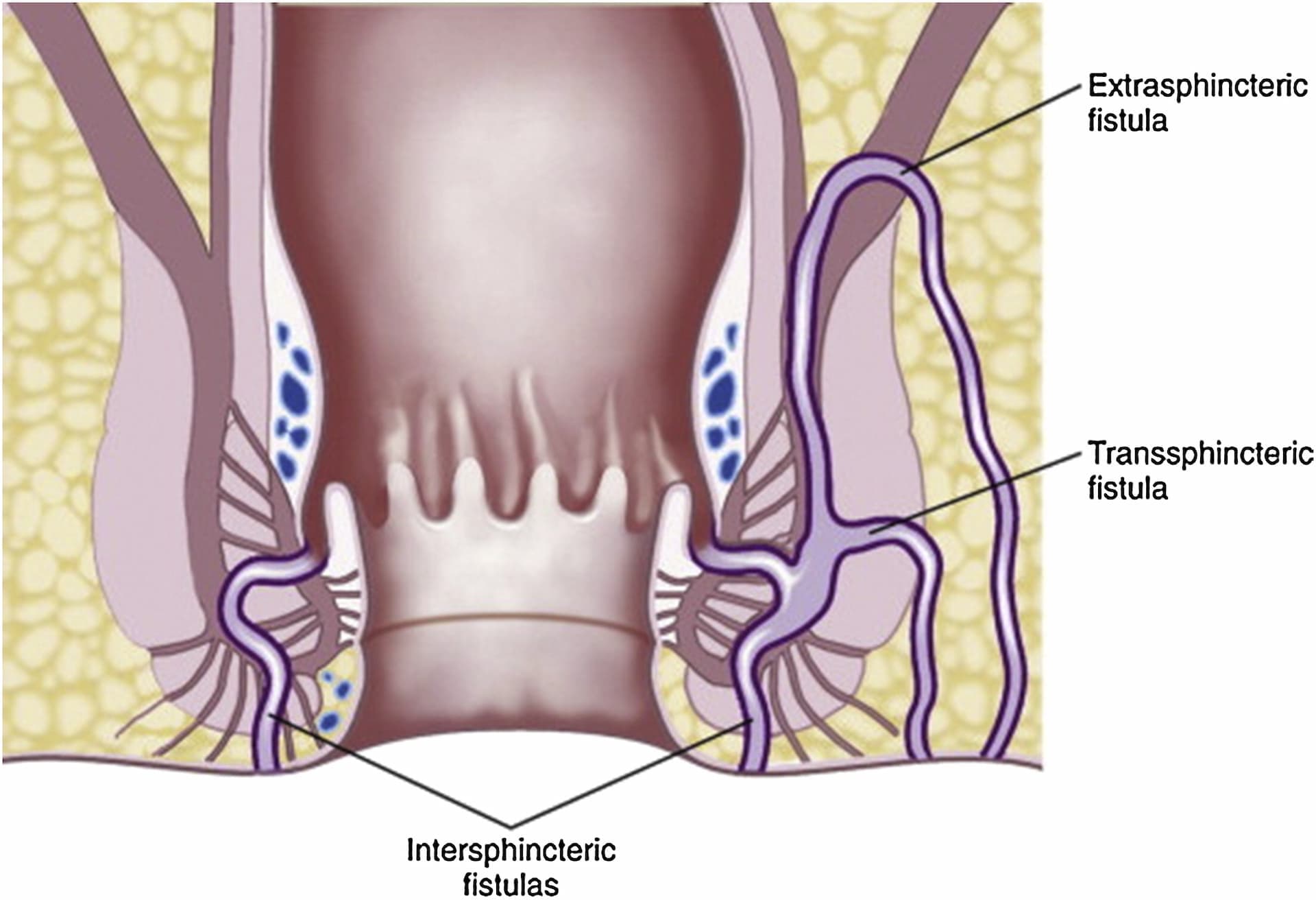 What Helps with Anal Fistula?