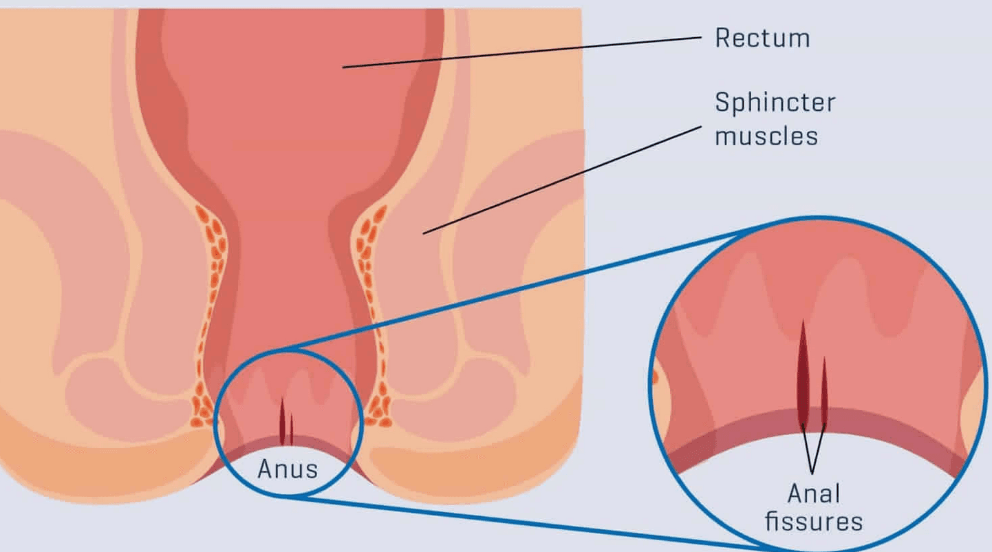 Anal-fissur-kendiliginden-gecer-mi