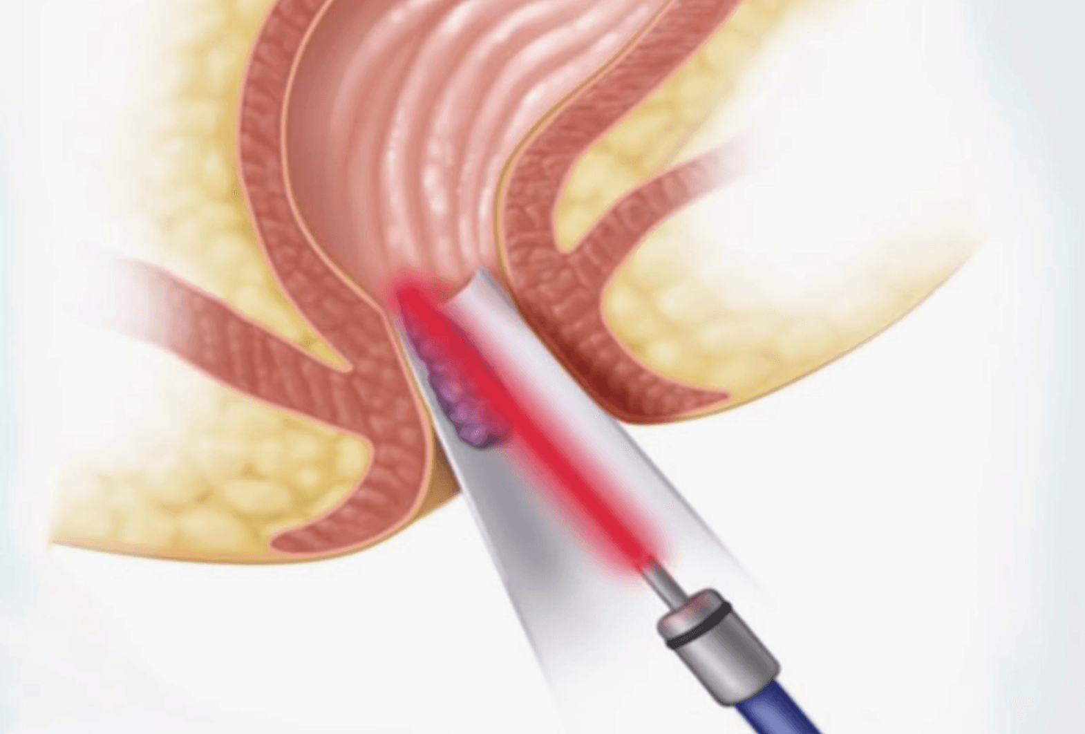 Anal-fissurlerde-lazer-tedavisi-nedir
