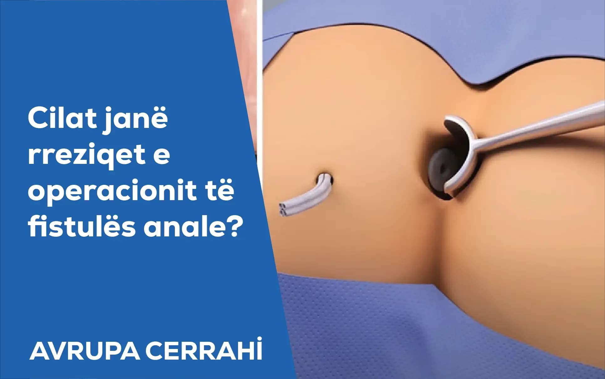 fistulës anale