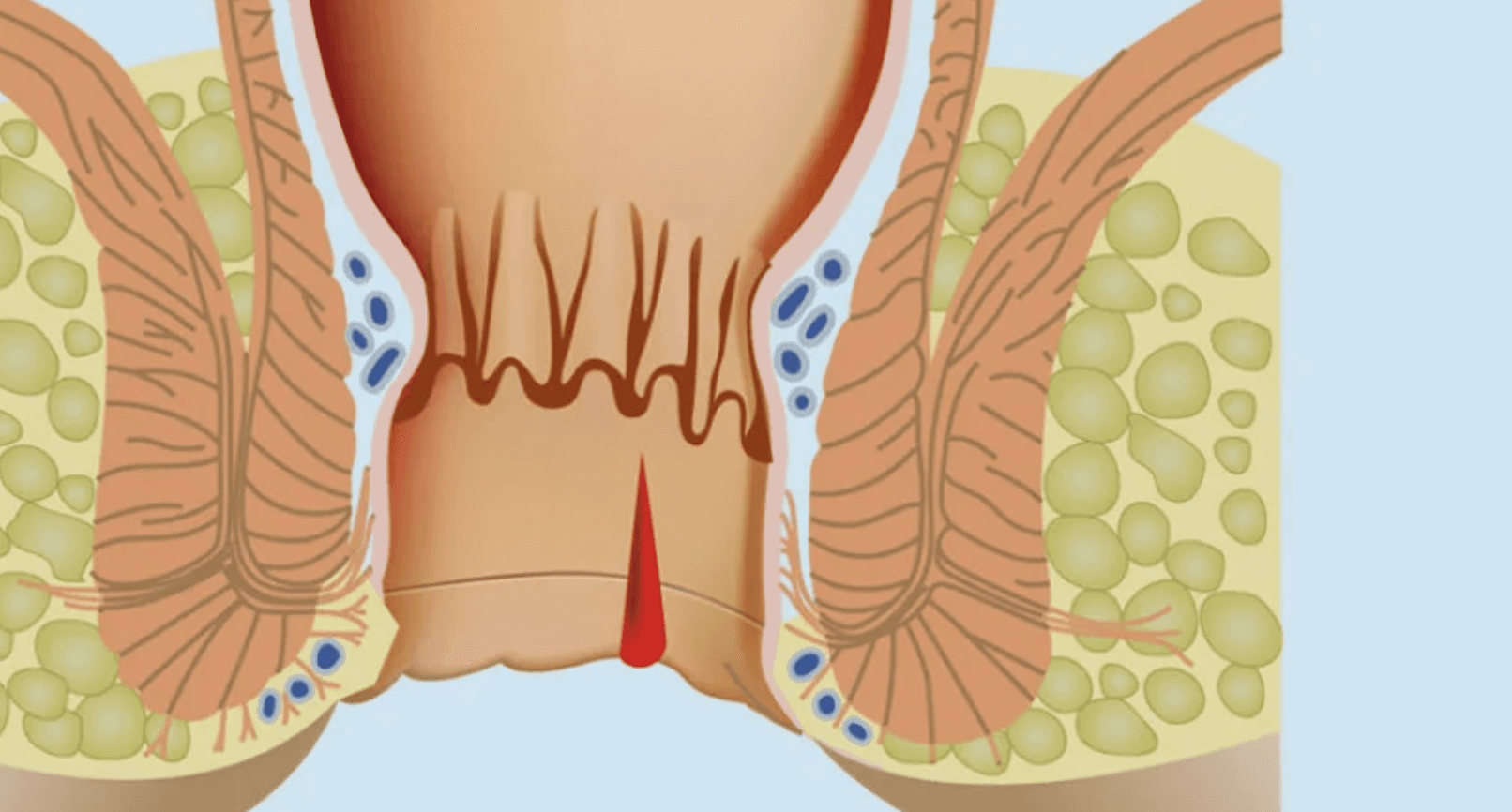 Hemoroid-Agrisinin-Nedenleri-Nelerdir