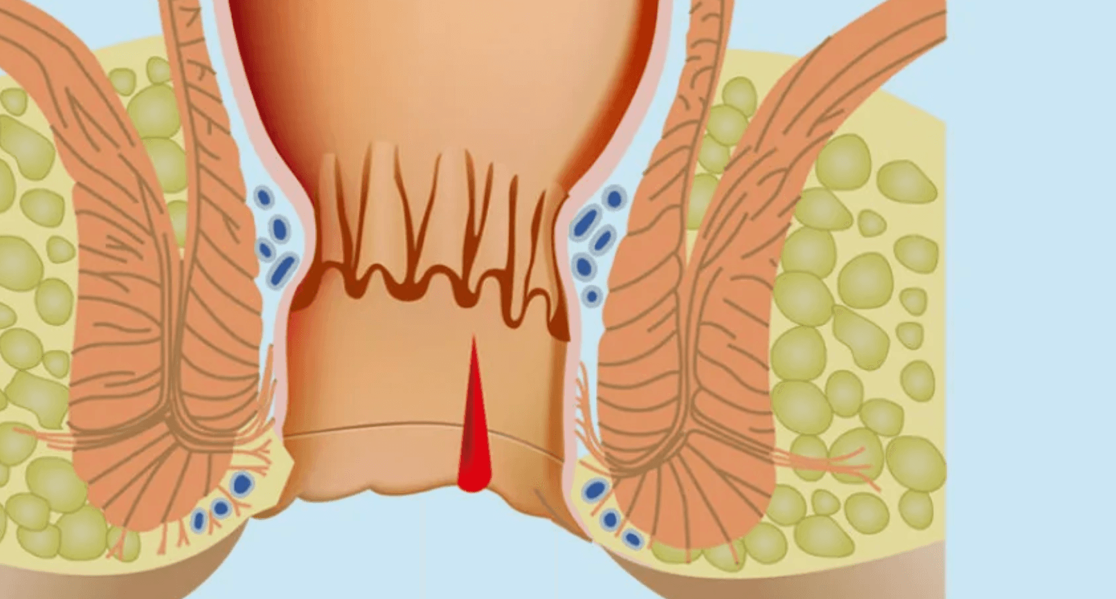 Hemoroid-Agrisinin-Nedenleri-Nelerdir