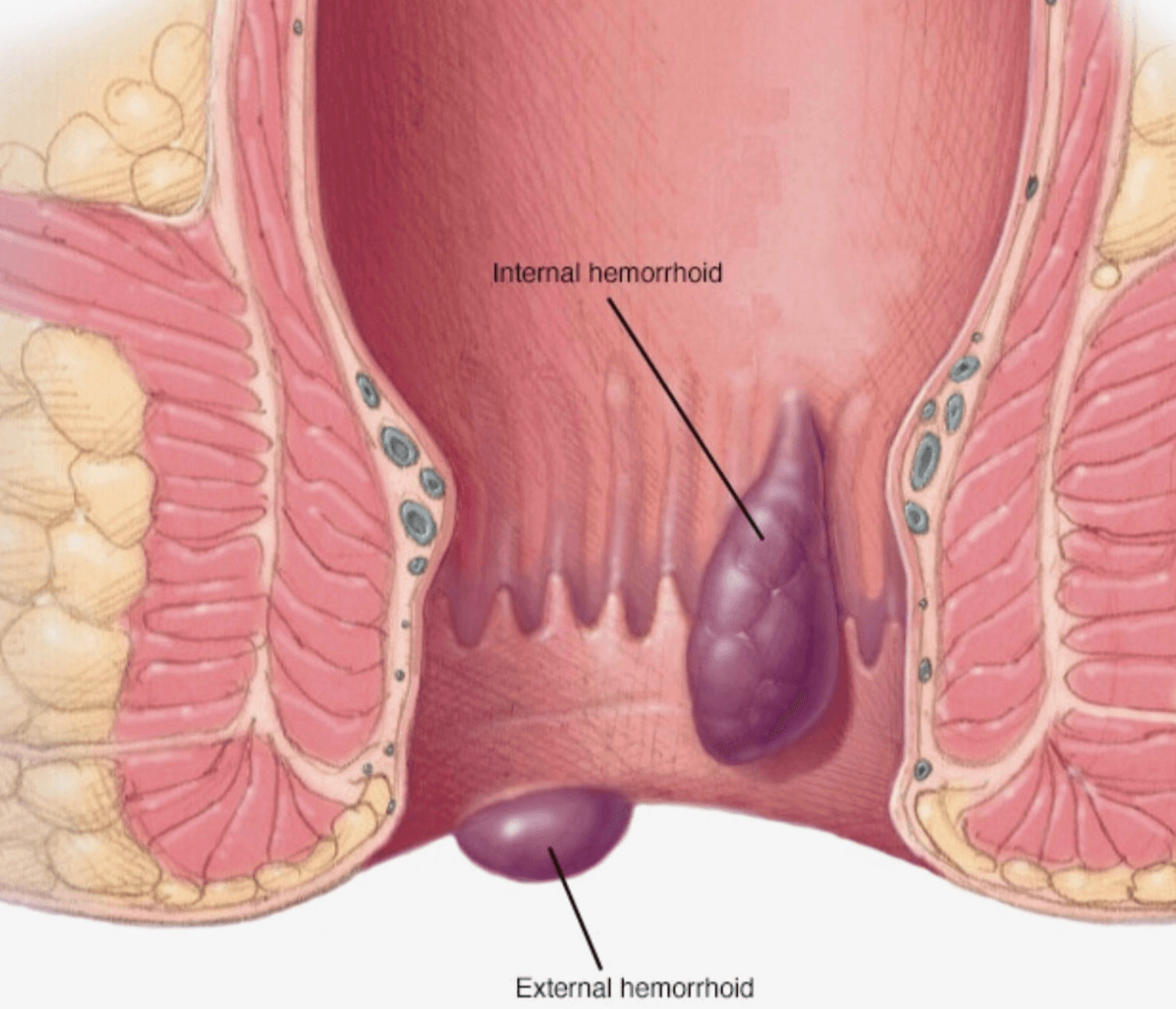 Hemoroid-Ameliyatsiz-Nasil-Tedavi-Edilir