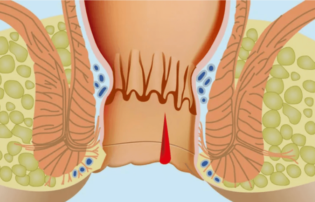 Hemoroid-Kendiliginden-Gecer-mi