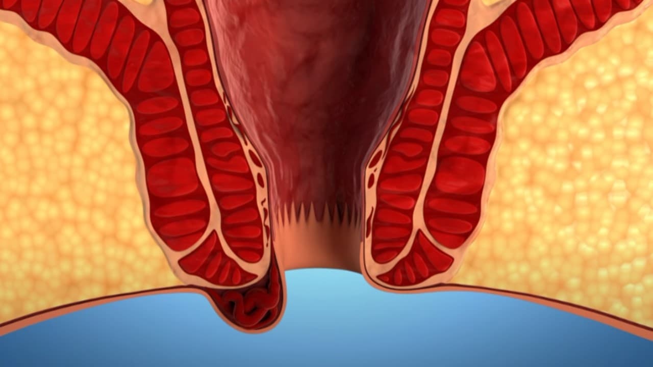 What are the Remedies for Hemorrhoids?
