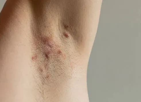 Hidradenitis-suppurativa