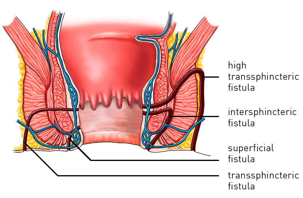 How Long Does the Healing Process for Anal Fistula Treatment