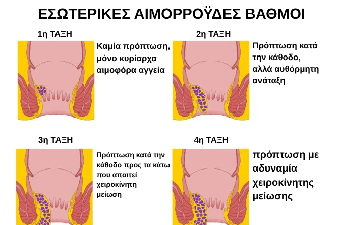 No-prolapse-just-preminent-blood-vessels