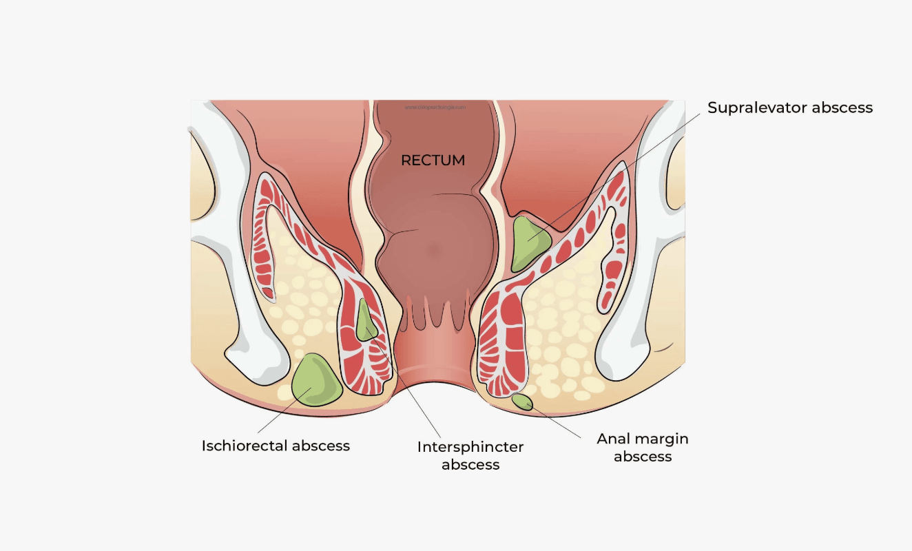 Perianal-Apse-Nasil-Olusur