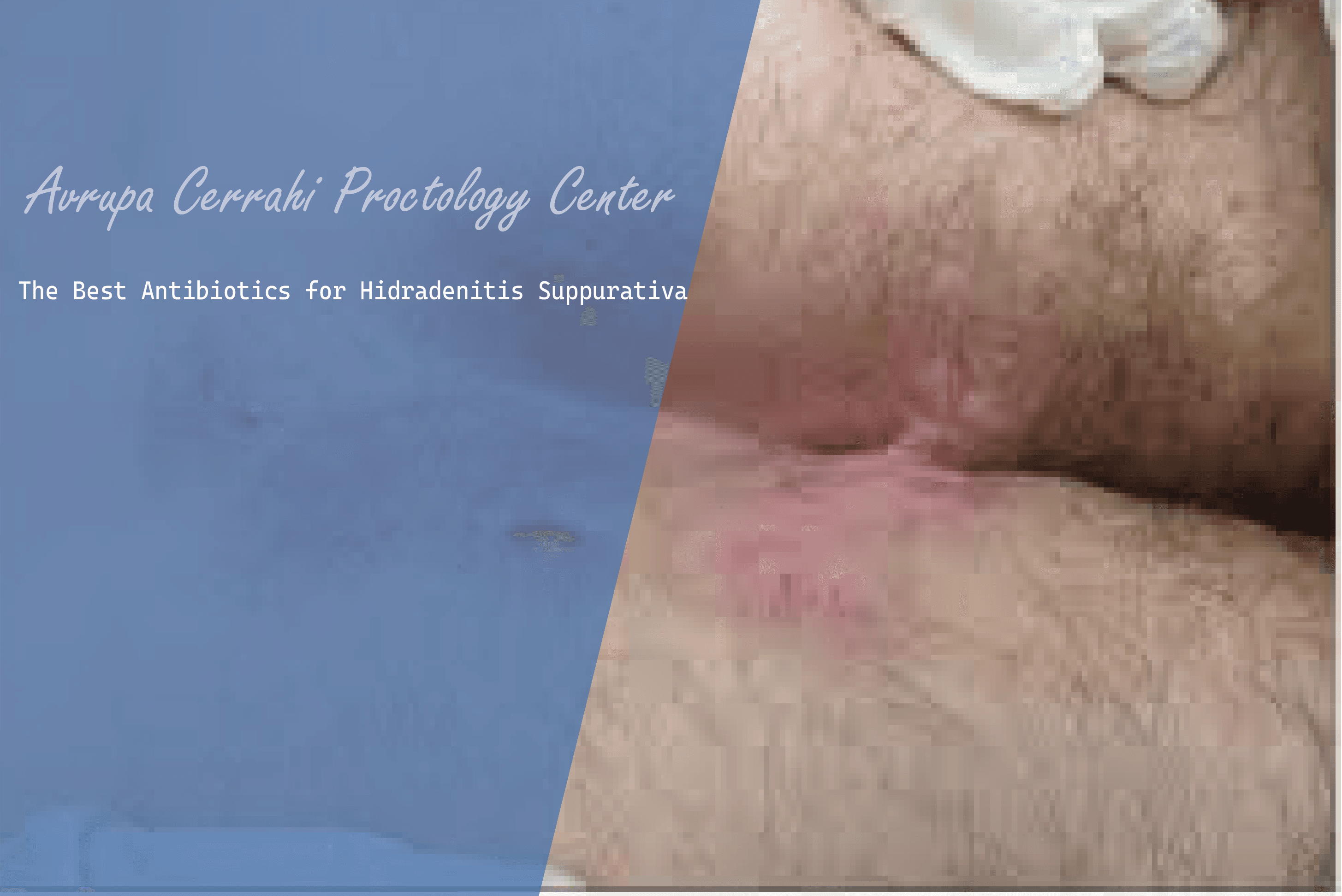 The Best Antibiotics for Hidradenitis Suppurativa