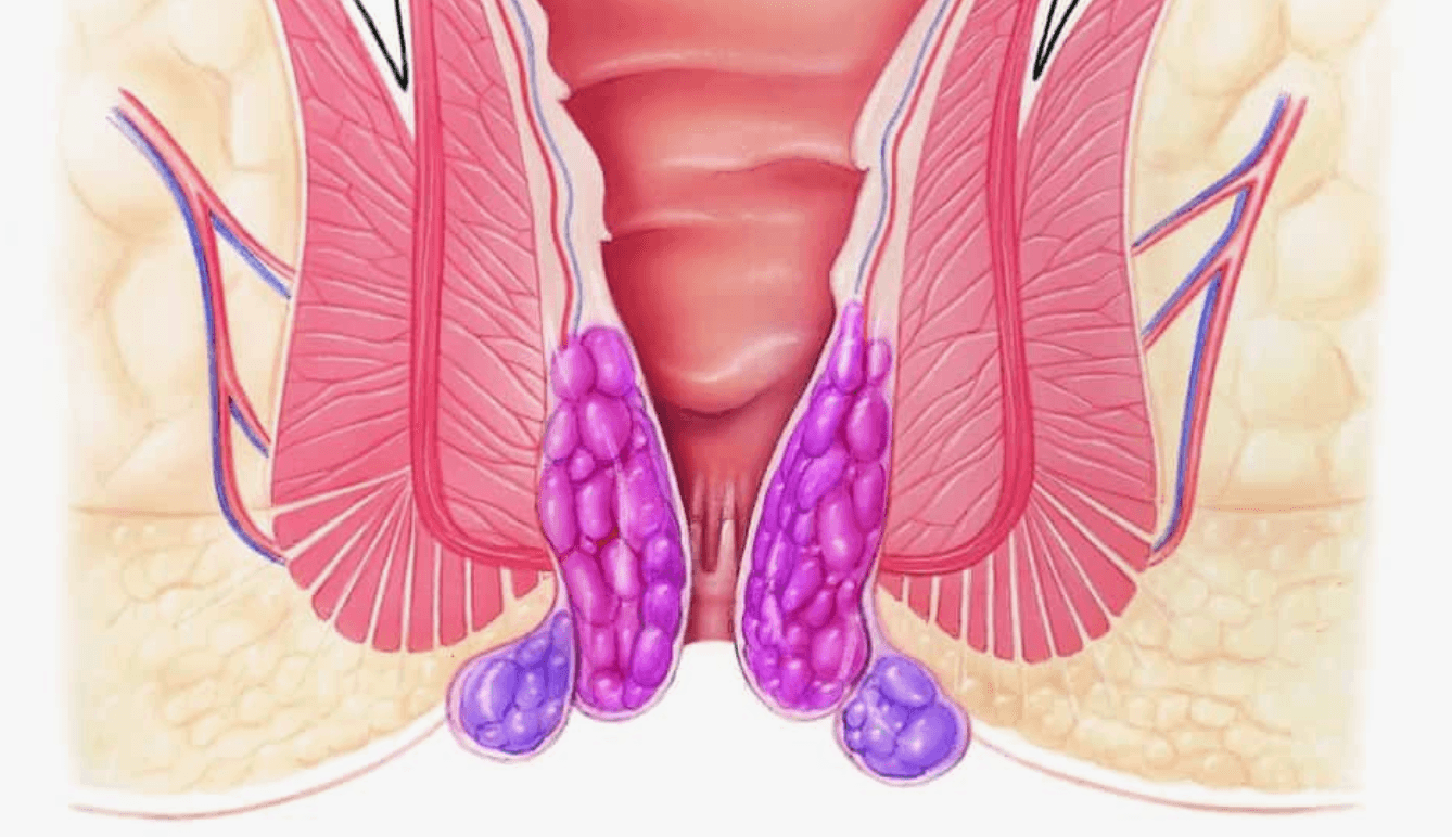 Tromboze-Hemoroid-Nedir