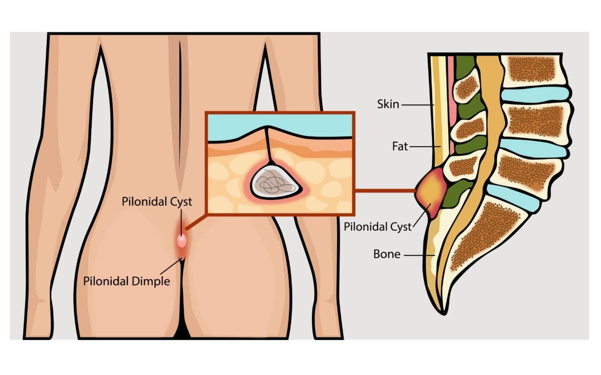 What Helps with Pilonidal Sinus?