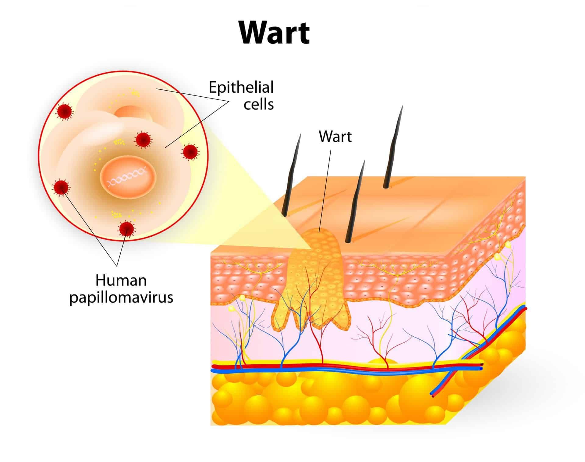 What Works Well for Warts?