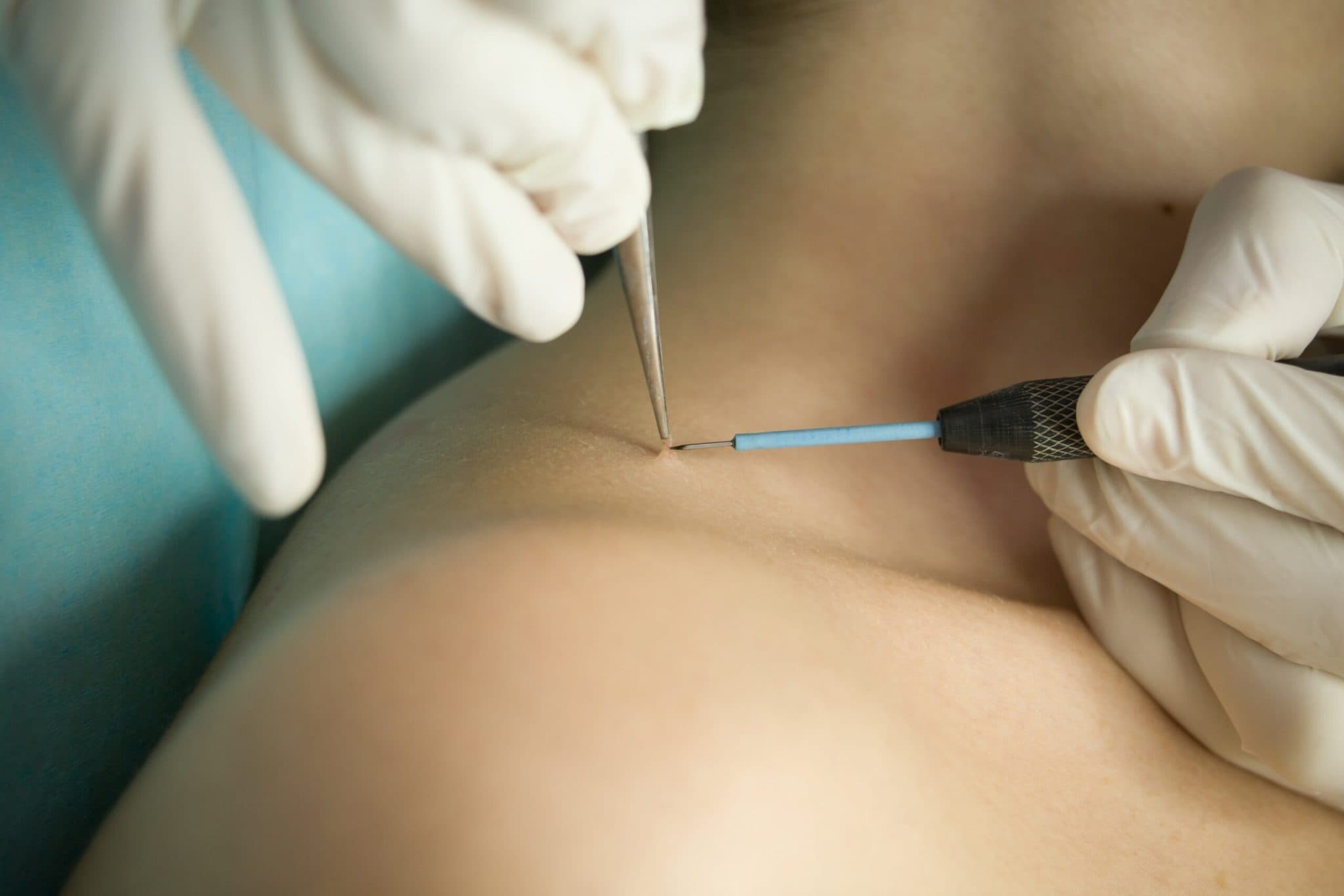 What are the Ways to Protect Against Warts?