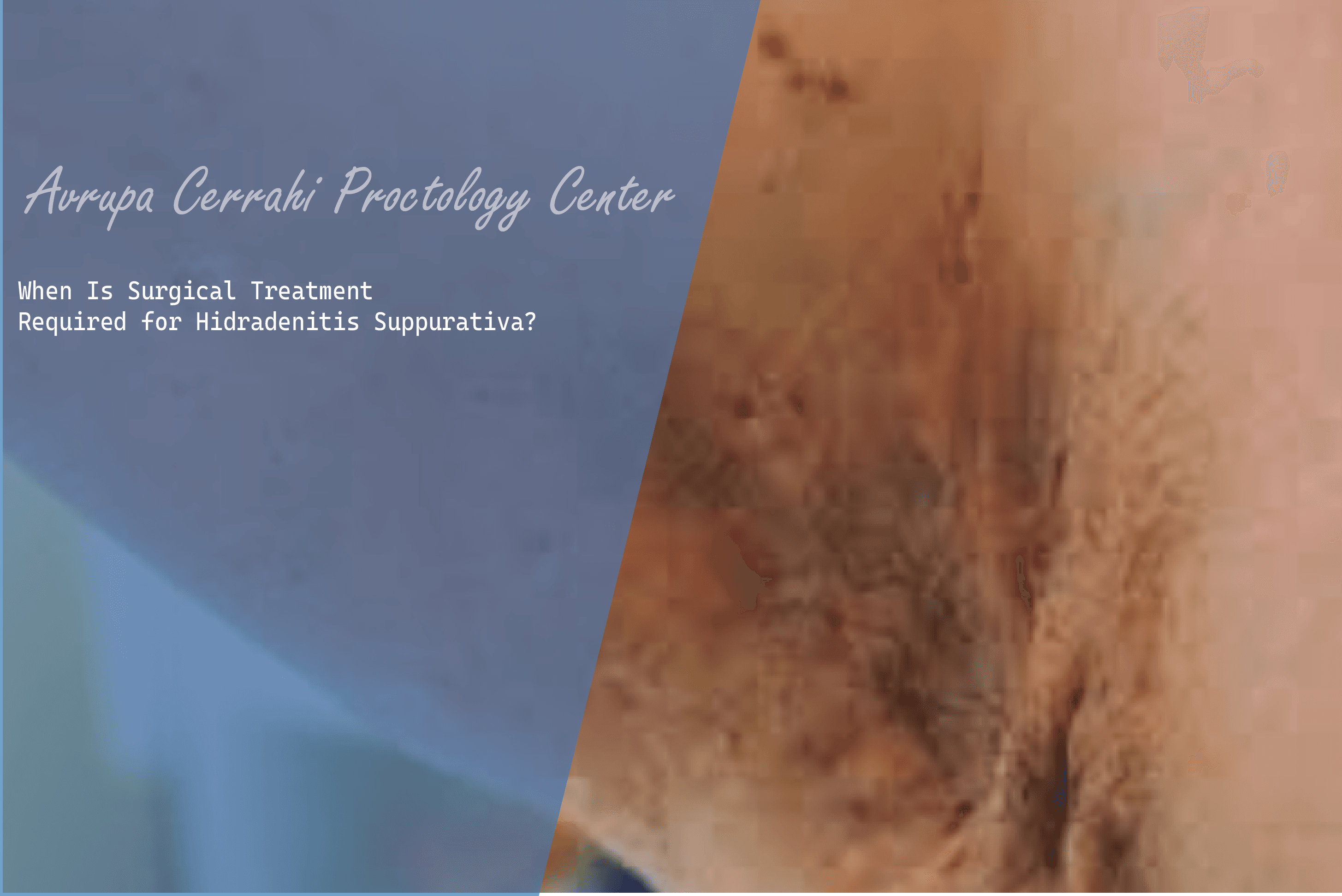 When Is Surgical Treatment Required for Hidradenitis Suppurativa?