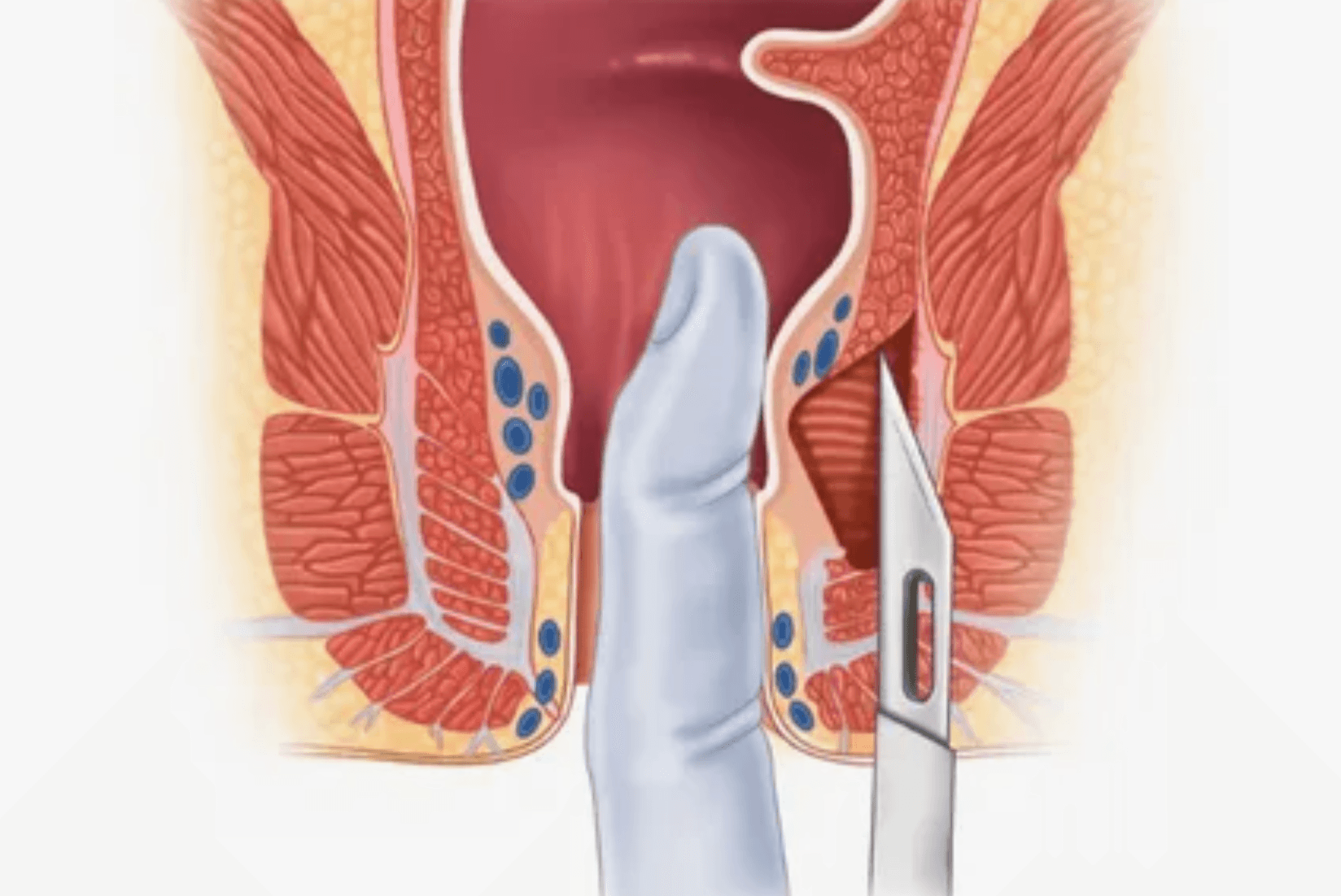 anal-fissur