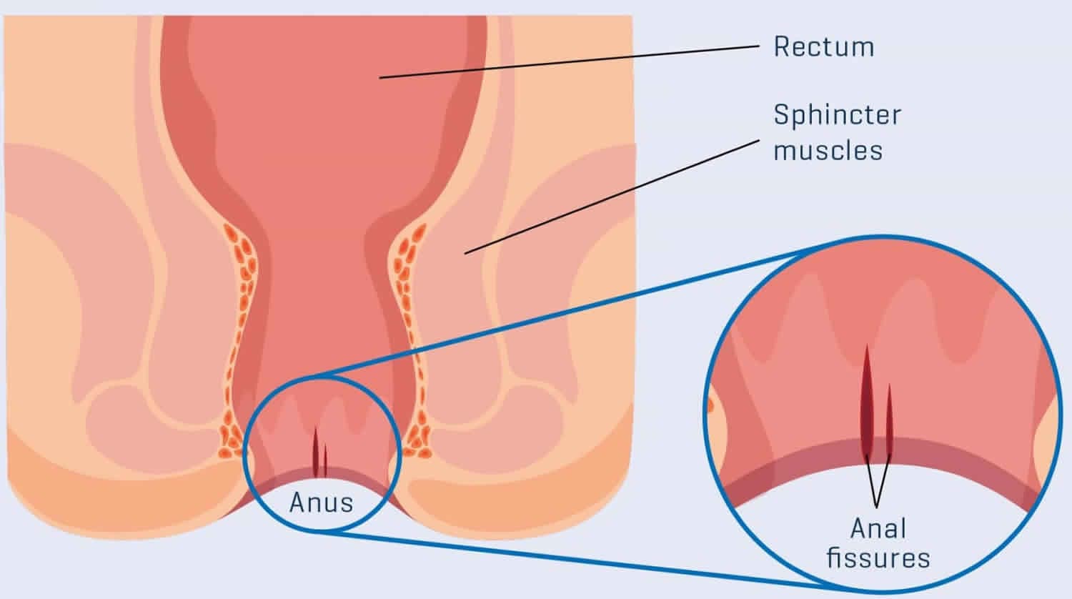 anal-fissur-nasil-ortaya