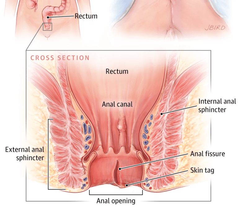 What Helps Anal Fissures?