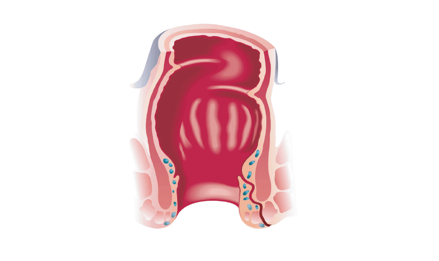 anal-fistul-1
