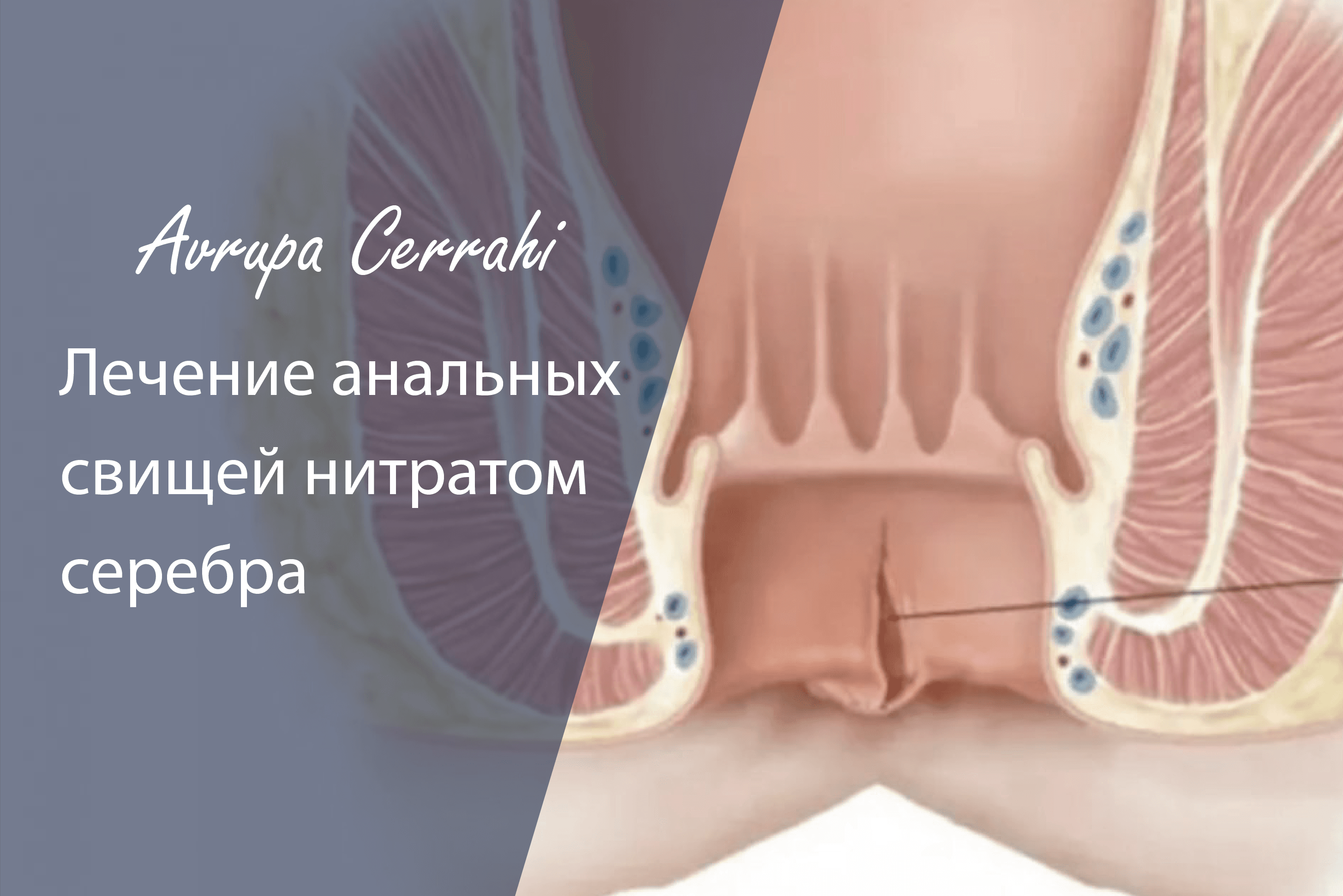 Лечение анальных свищей