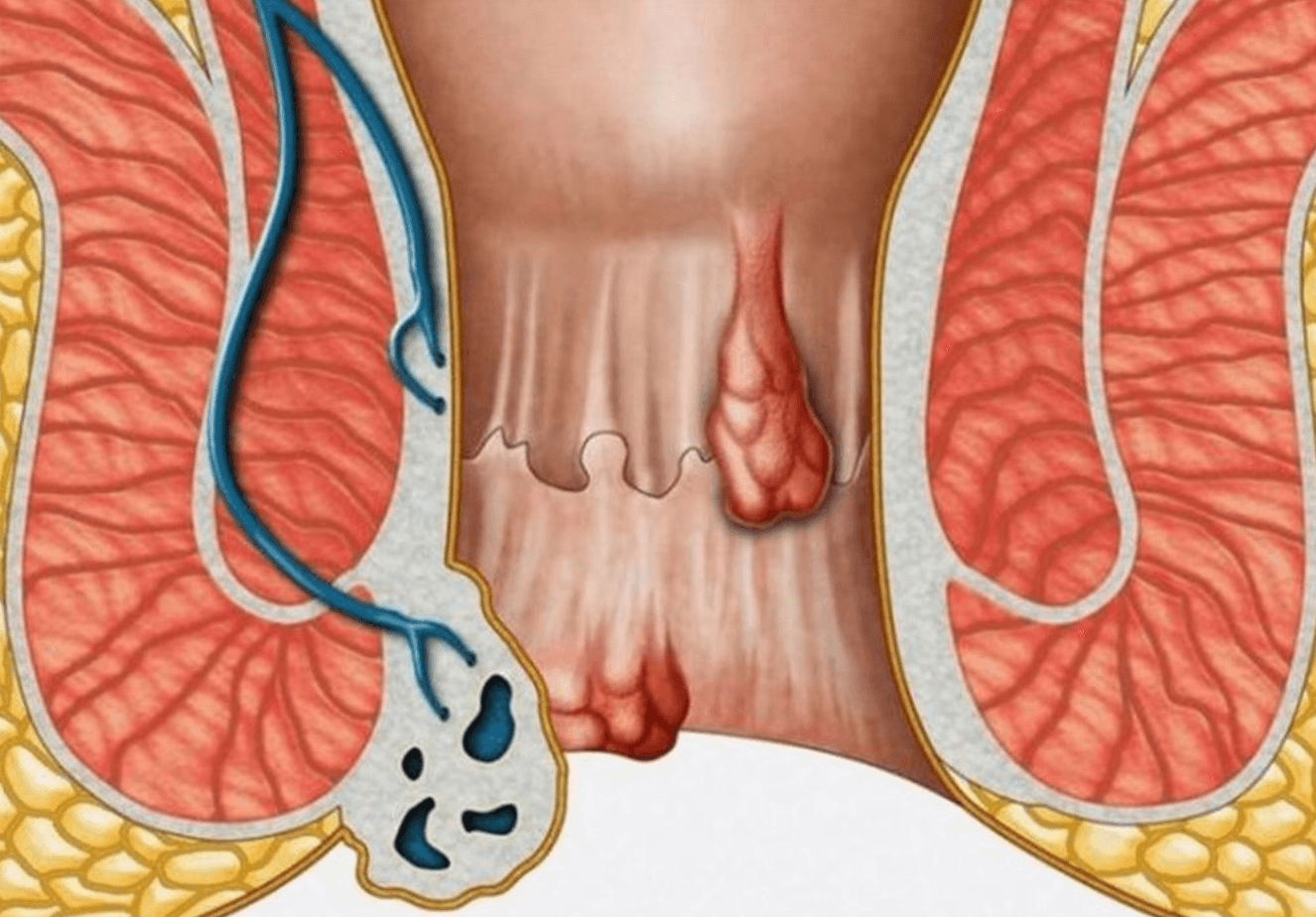 anal-fistul-nasil-olusur-1