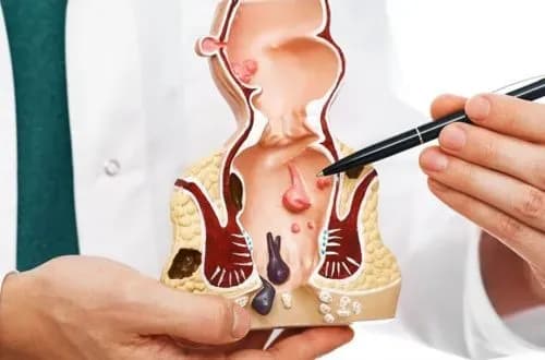 anal-fistul-nedir-nasil-tedavi-e