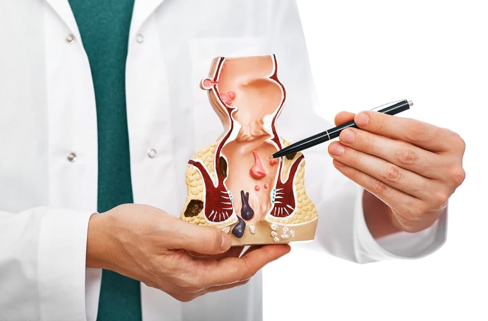 anal-fistula-1