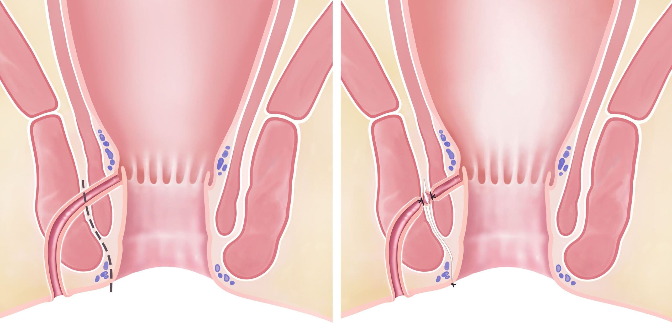 anal-fistula