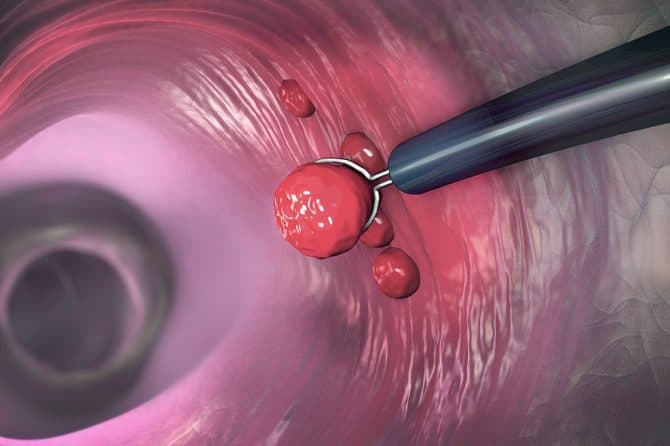 anal-polip-belirtileri-nelerdir18-670x446