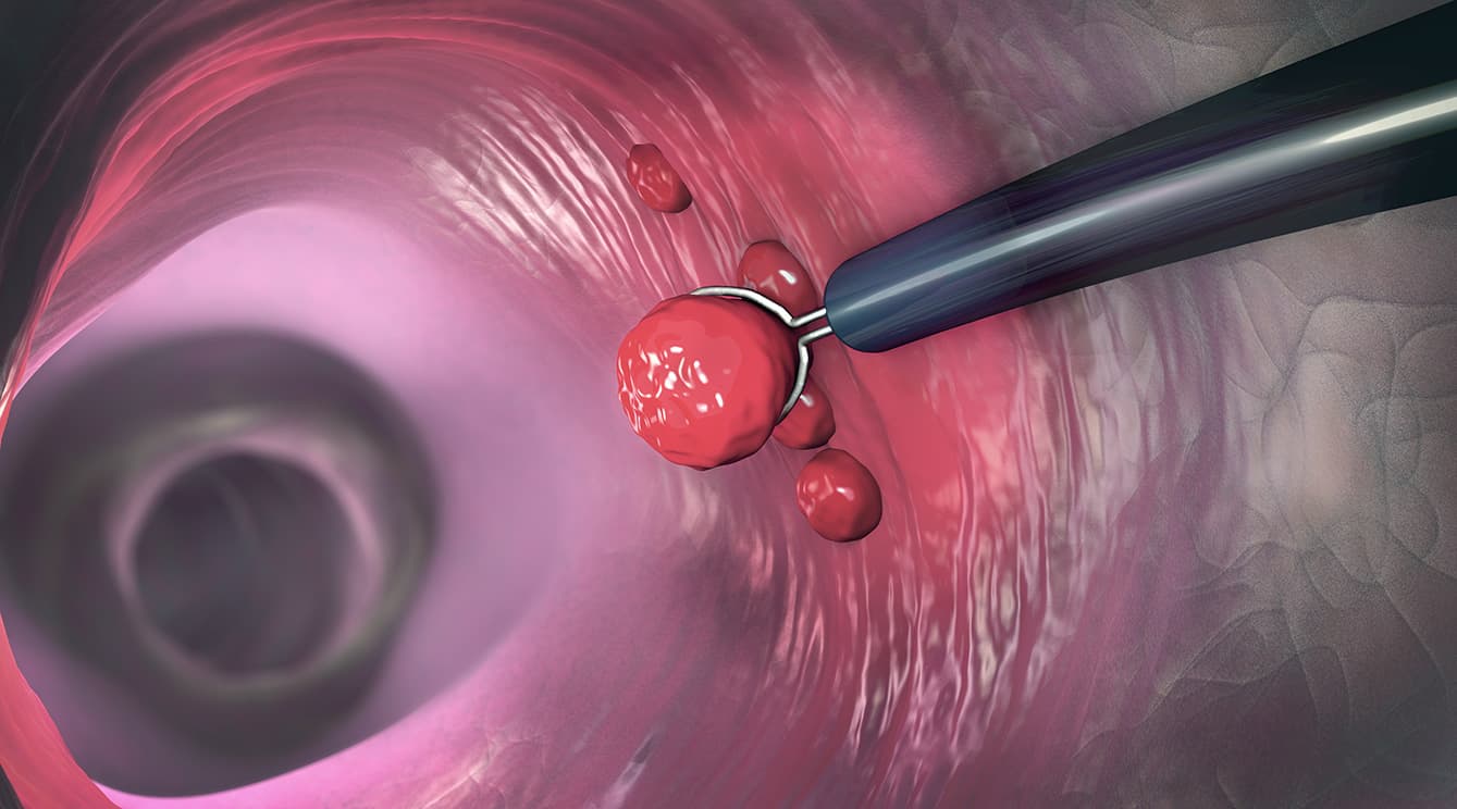 Anal polyp symptoms illustration