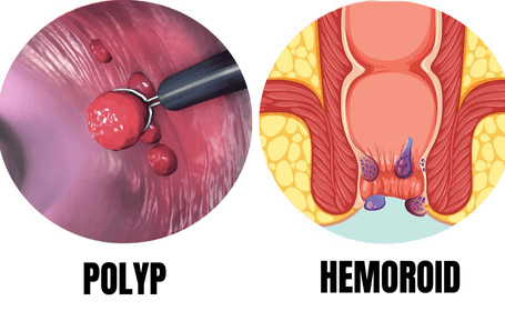 anal-polip-ile-hemoroid-arasindaki-farklar-nelerdir
