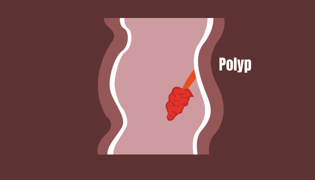 anal-polip-nedir12