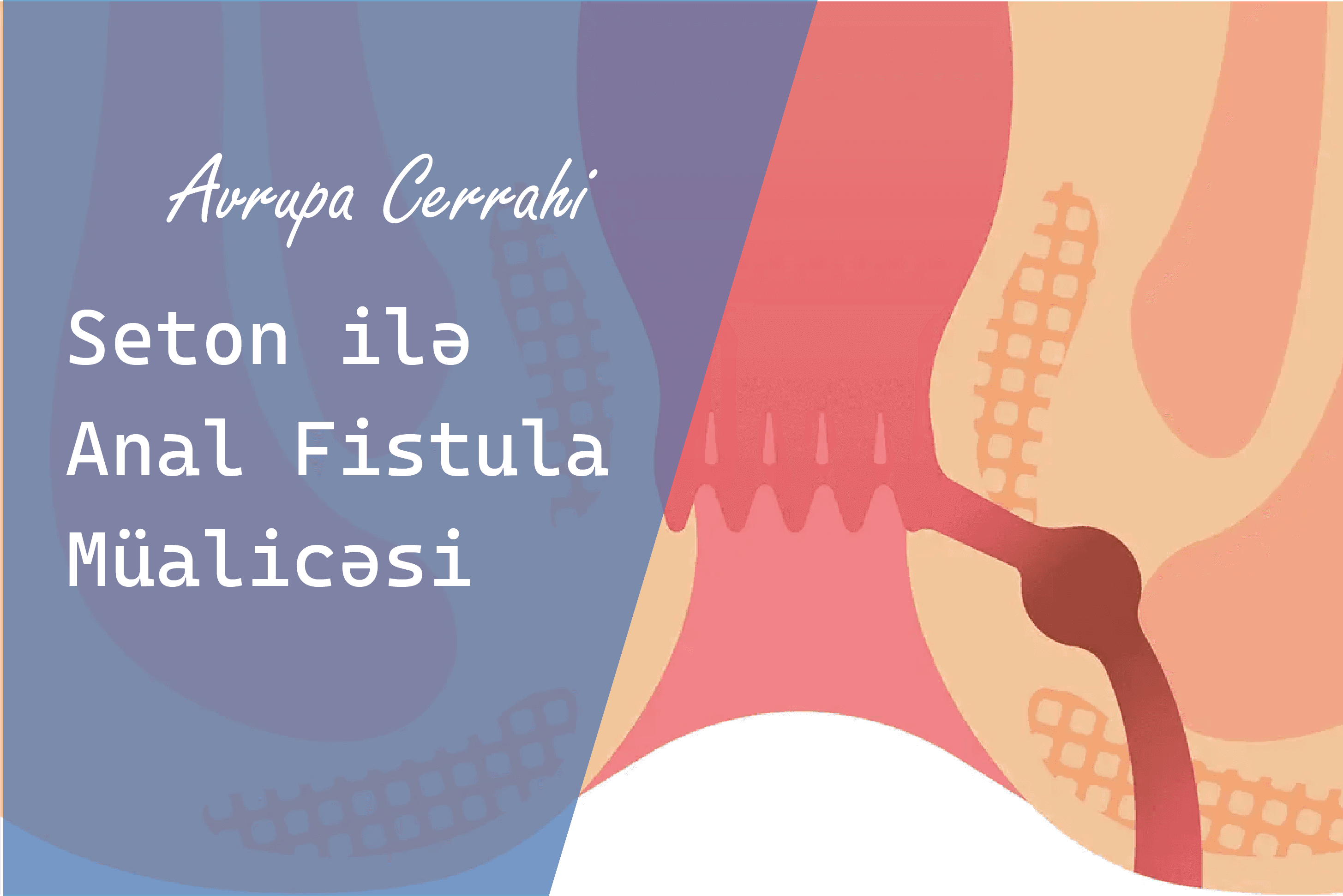 anal fistula