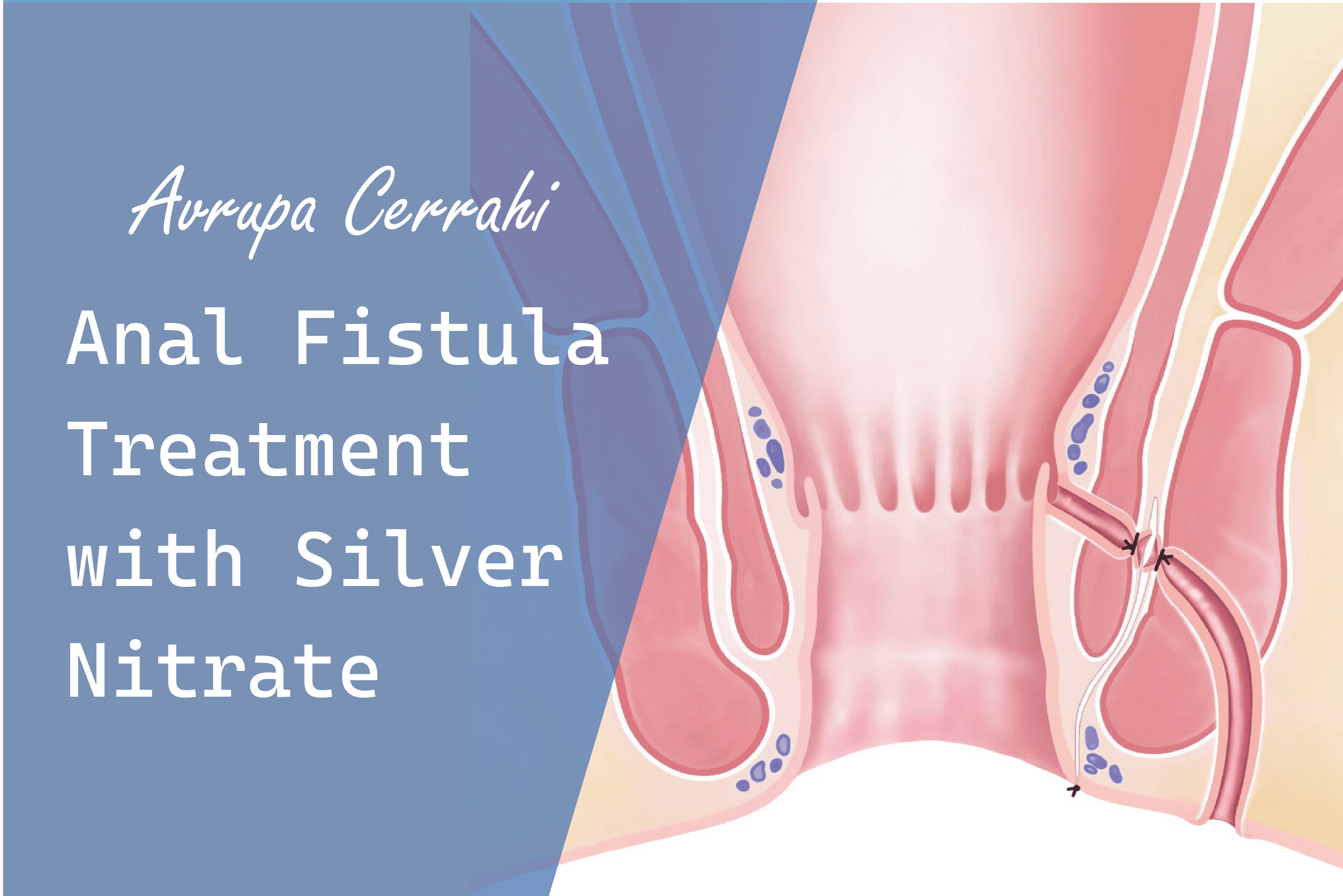 anal fistula