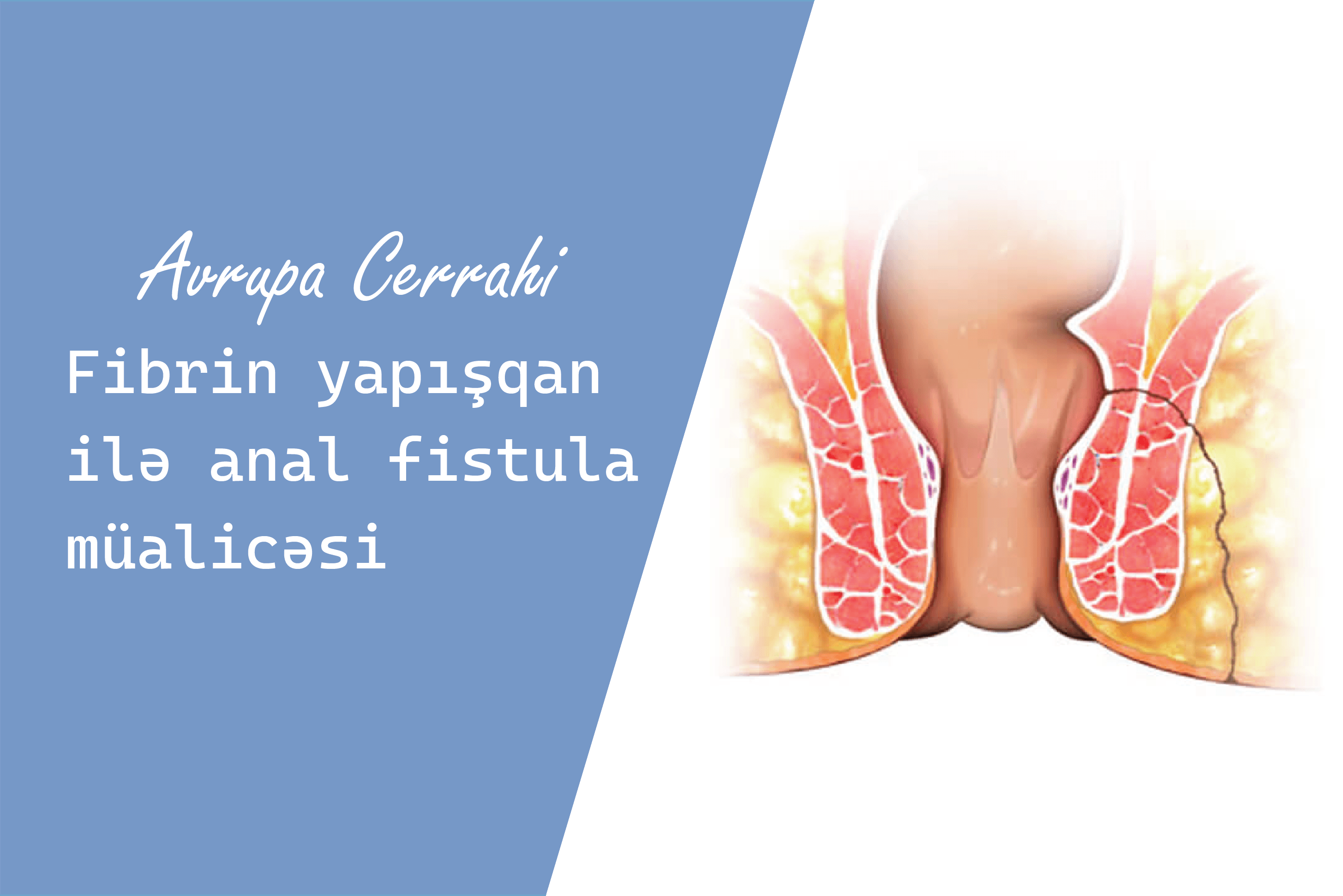 anal fistula