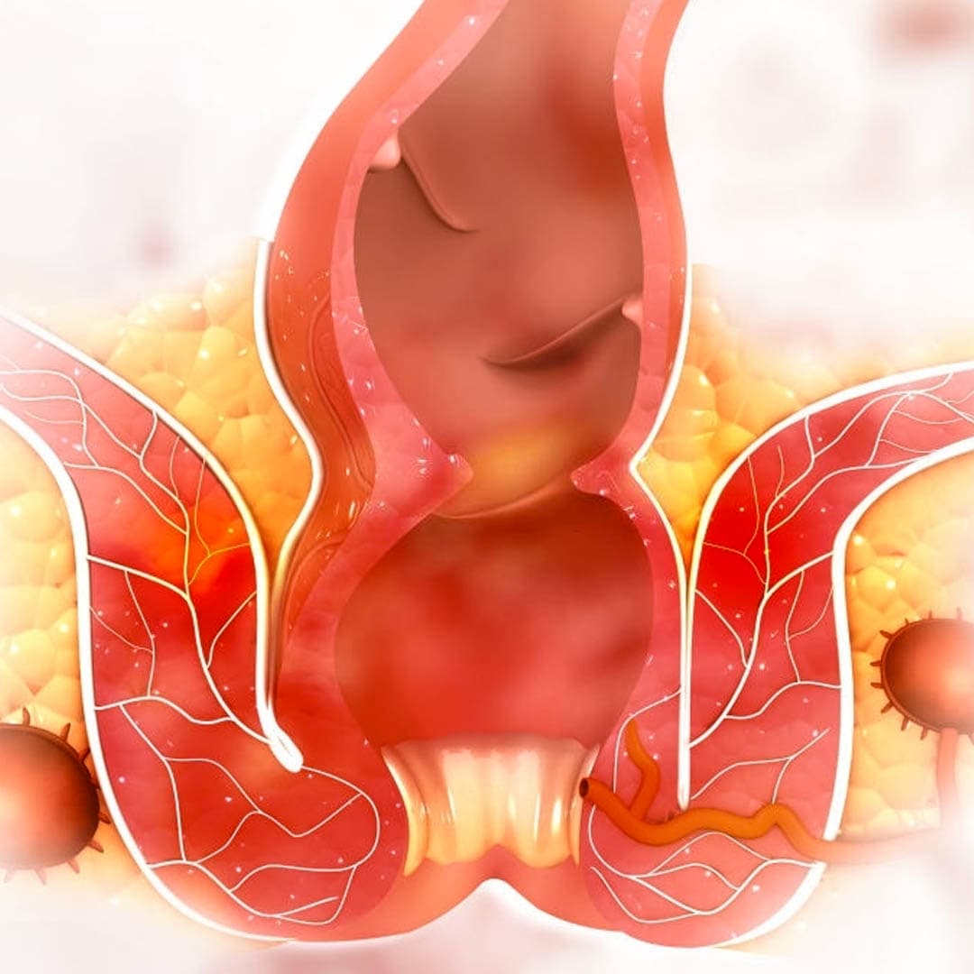 hemoroid-basur-belirtileri-1