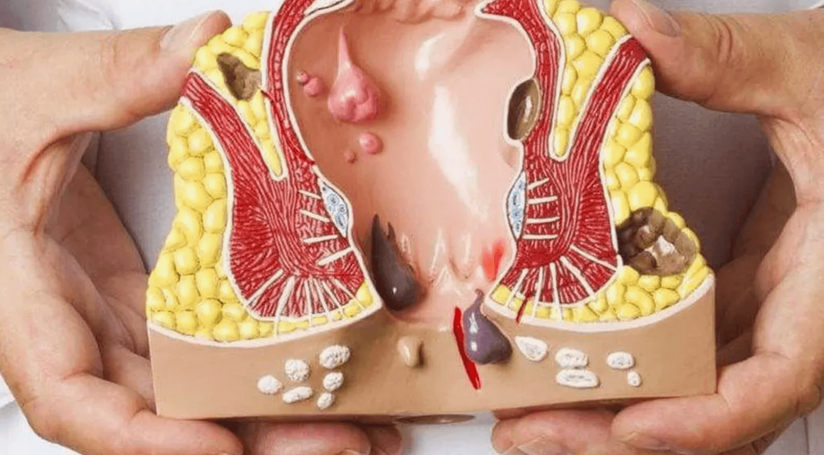 hemoroid-cesitleri
