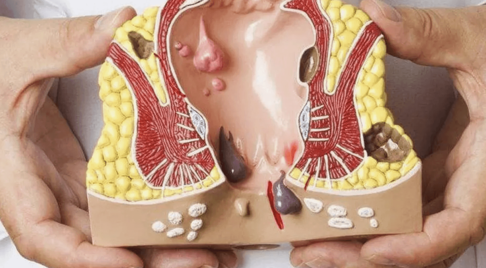 hemoroid-cesitleri