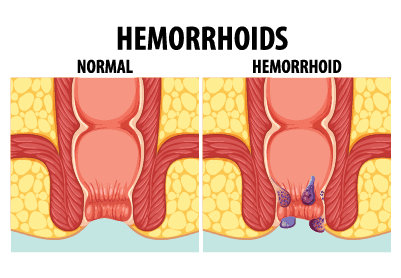 hemoroids