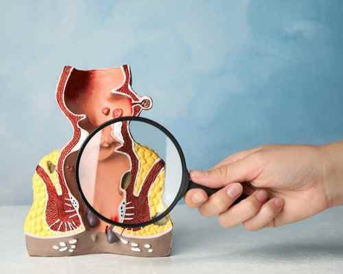 What happens if haemorrhoids are not treated?