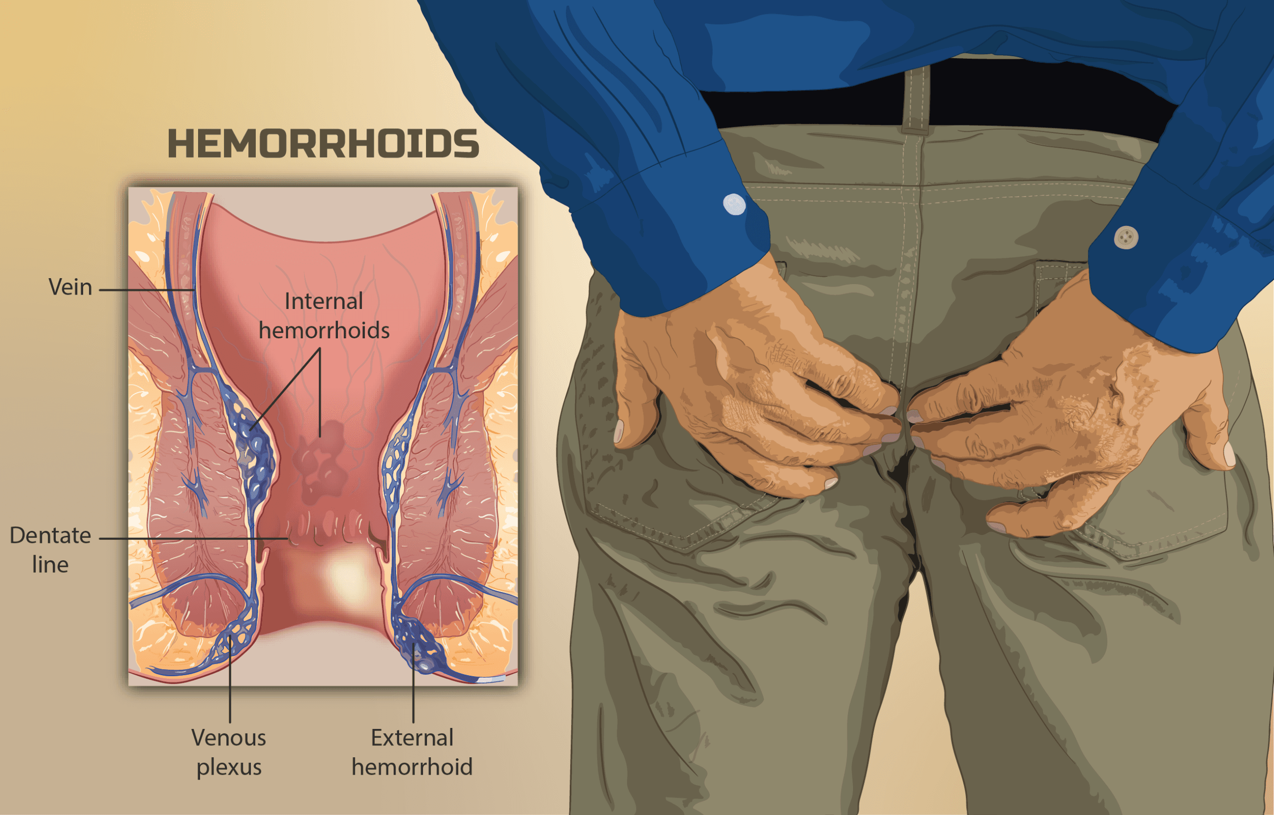 hemorroids-scaled