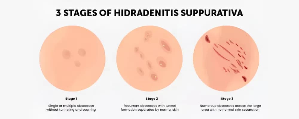 hidradenitis-suppurativa-11-1