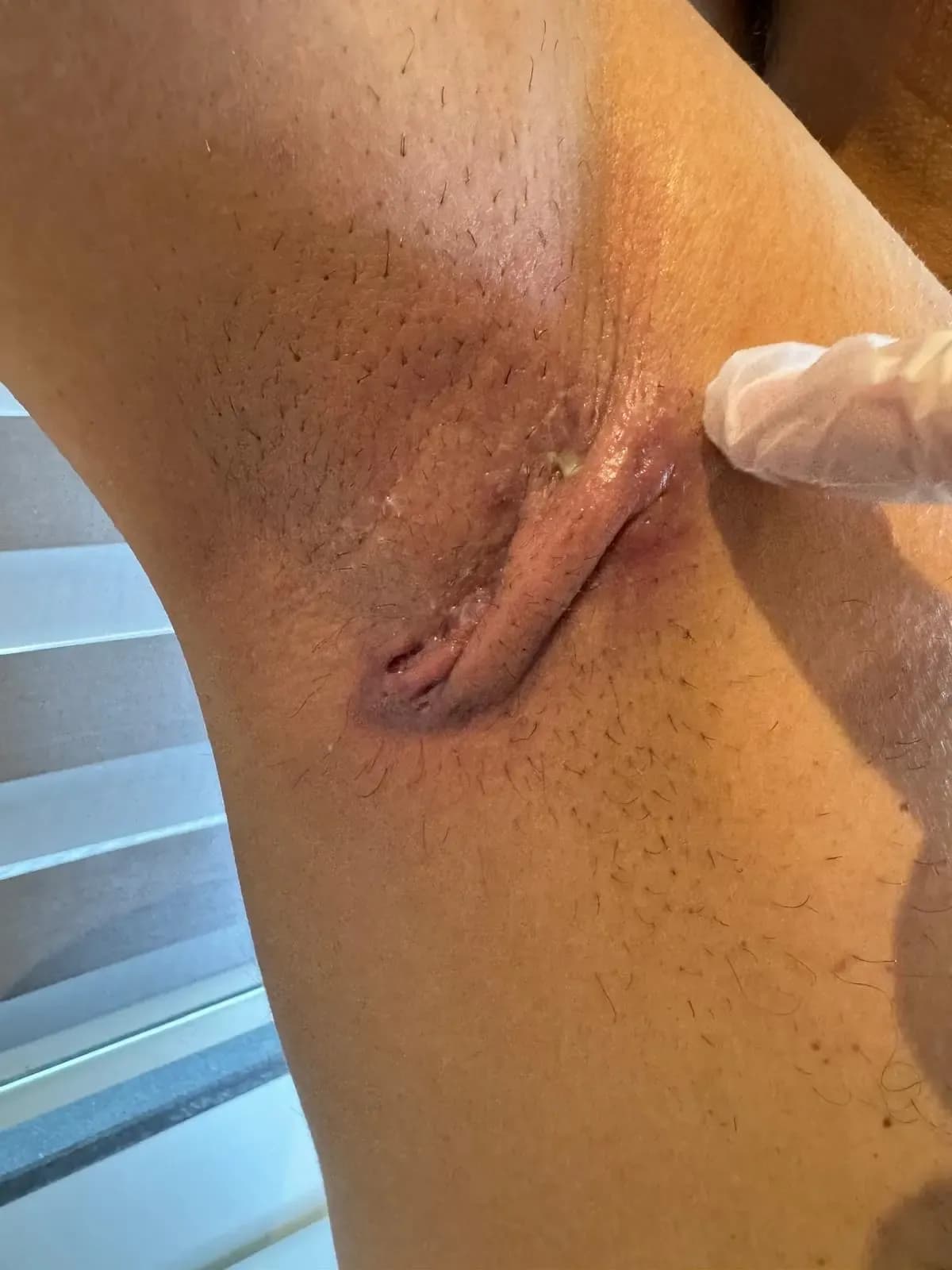 hidradenitissuppurativa