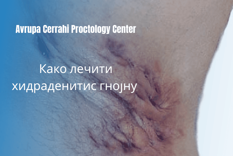 how-to-treat-hs-blog-serbia