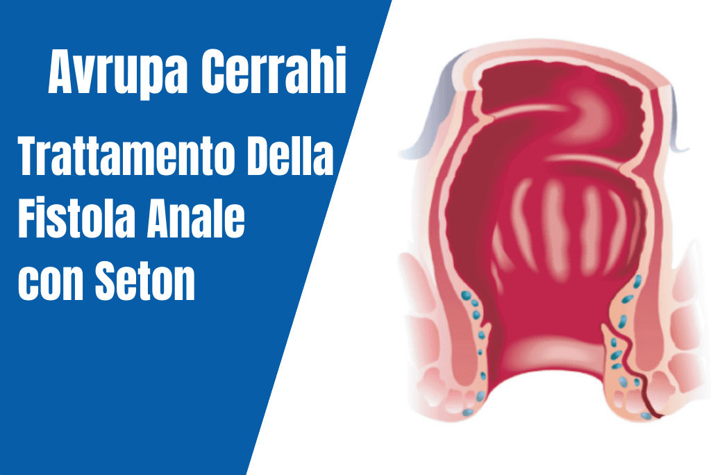 italyanca-seton
