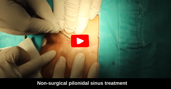 plonidal-sinus-2