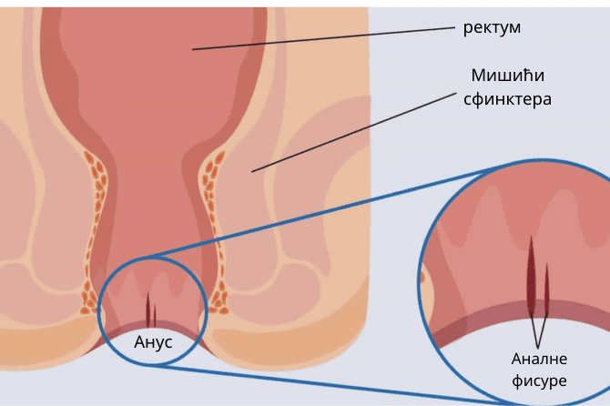 serbia-blog-anal-fissur-foto